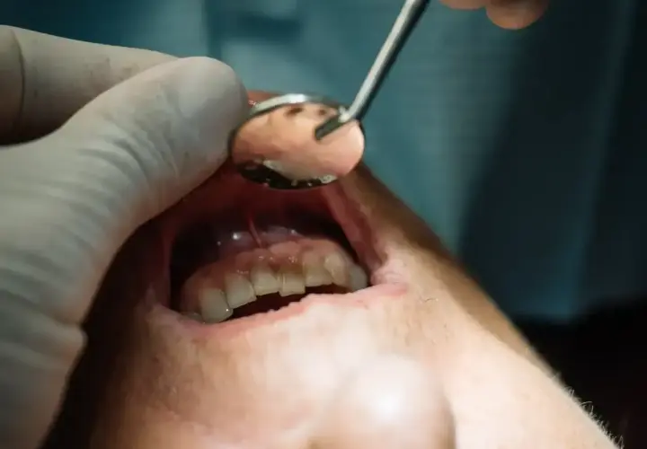 Dentysta używa lusterka, by sprawdzić, co wyciąga ropę z zęba.