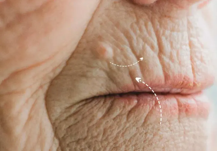 Primer plano de arrugas en el labio superior, mostrando la textura de la piel madura y un pequeño bulto.