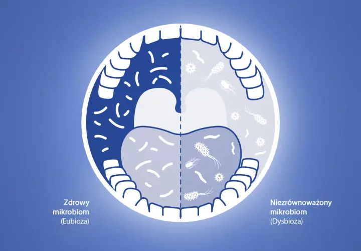 Porównanie zdrowego i niezrównoważonego mikrobiomu jamy ustnej. Po lewej zdrowy, po prawej dysbioza, gdzie chlorhexidine może pomóc.