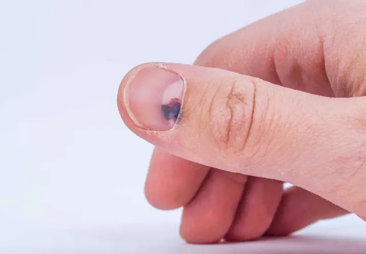 Ein blauer Fleck unter dem Fingernagel, vielleicht durch einen Stoß. Hausmittel können bei solchen Blutergüssen helfen.