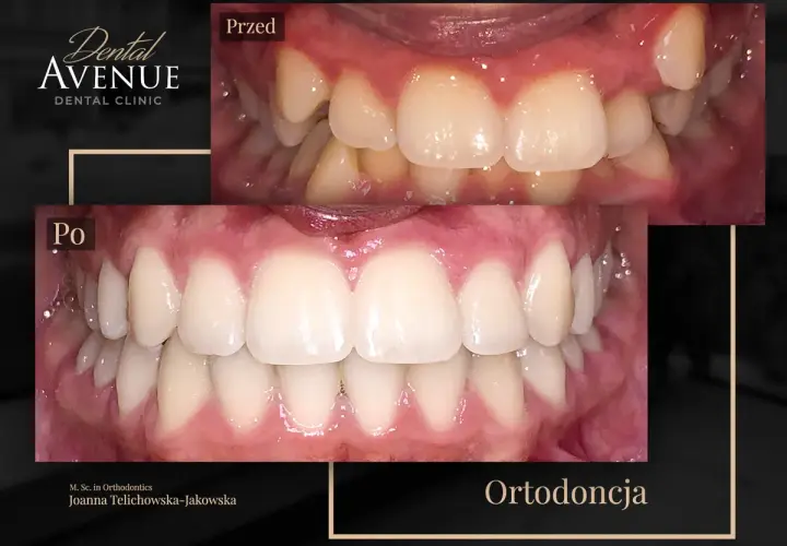 Aparat ortodontyczny przed i po: krzywe zęby wyprostowane, piękny uśmiech. Ortodoncja w Dental Avenue.