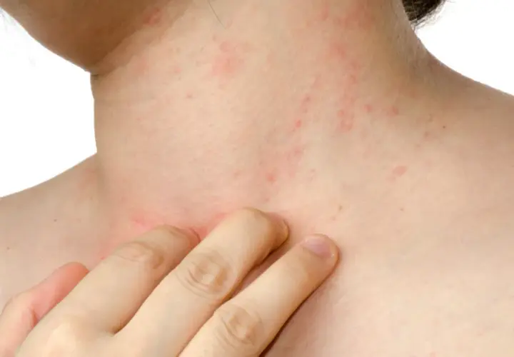 Pelle arrossata e irritata sul collo e sul petto, con piccole macchie rosse, sintomo di dermatite da stress.