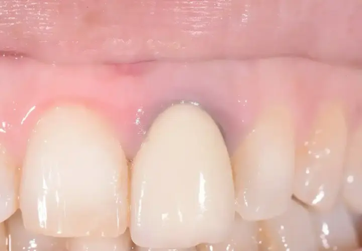 Dettaglio di denti con una corona e gengive rosa, con alcune aree che mostrano sfumature di gengive nere.