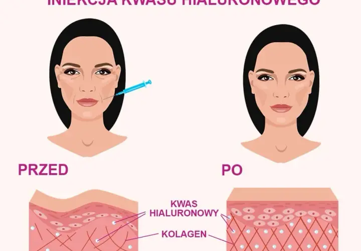 Kwas hialuronowy: jak działa i dlaczego Twoja skóra go pokocha?