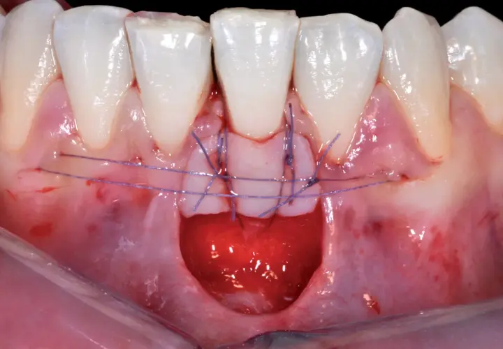 Primo piano di un innesto gengivale con suture viola che fissano il tessuto.
