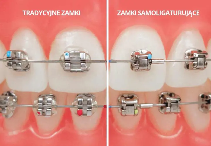 Ile trwa aparat na zęby? Czas leczenia i realne efekty