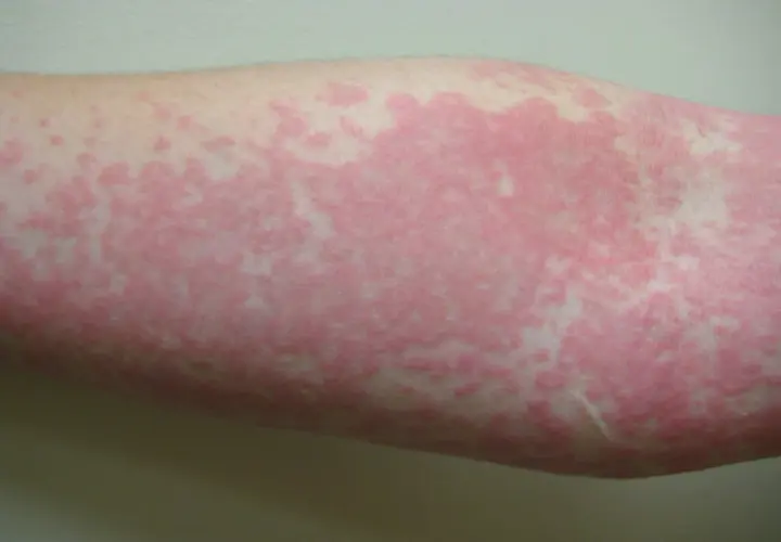 Roter, fleckiger Hautausschlag am Arm, möglicherweise ein Symptom von Corona.