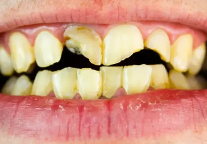Dientes amarillentos y rotos, con caries visibles. Un triste reflejo de los dientes de drogadicto, que muestran el devastador efecto de las adicciones en la salud bucal.