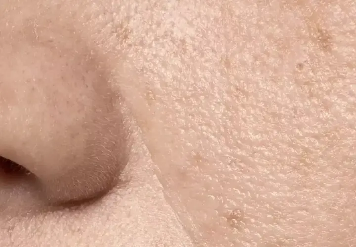 Primer plano de la piel, mostrando la textura y los poros visibles. Se aprecian pequeñas imperfecciones y la delicada superficie.