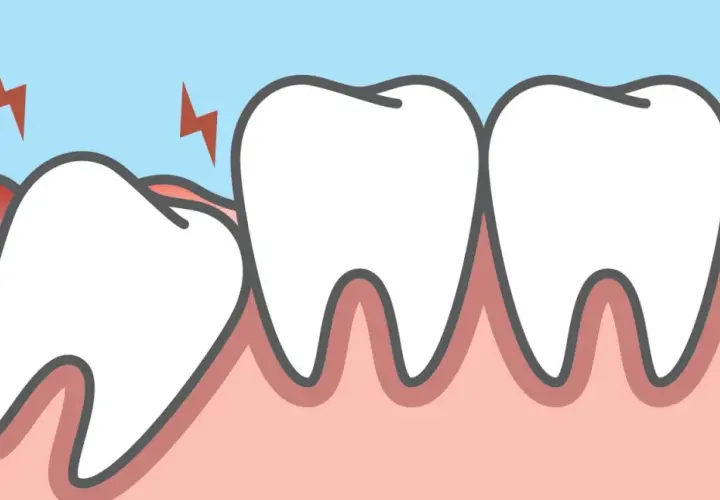 Dente incapsulato che fa male, con fulmini rossi che indicano dolore e gengiva infiammata.