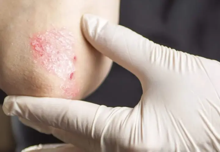 Gomito di un bambino con psoriasi, esaminato da una mano guantata.