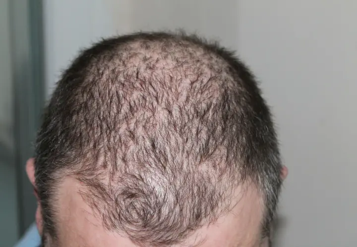 Huvud med tunt hår, visar fläckar av håravfall. Möjlig indikation på alopecia areata behandling.