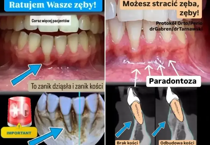 Paradontoza: przed i po leczeniu. Widoczne zaniki dziąseł i kości, a także efekty odbudowy.