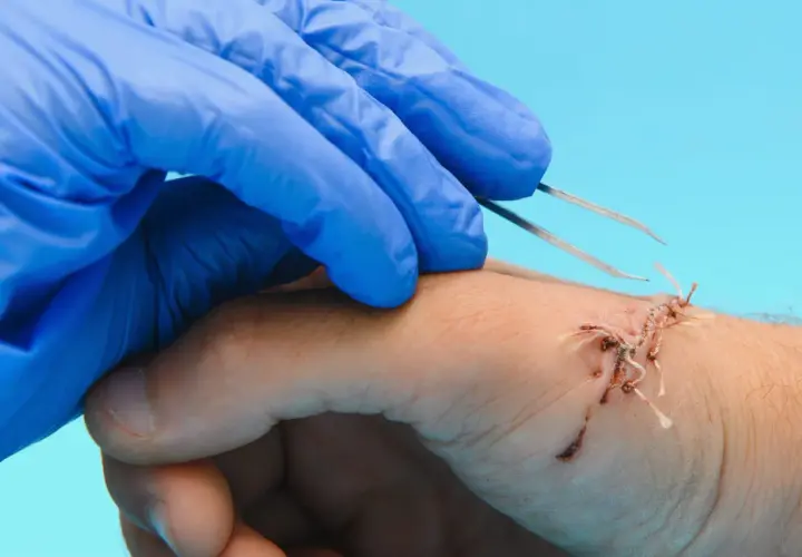 Main d'un professionnel en gant bleu utilisant une pince pour enlever un point de suture sur une main blessée.