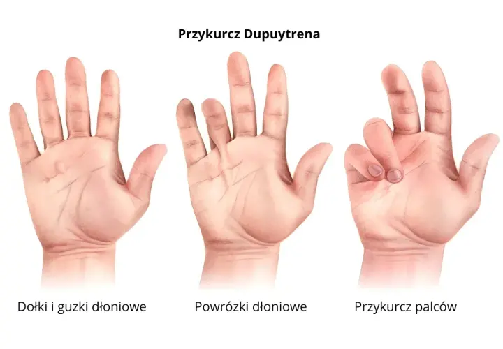 Trzy dłonie pokazujące postęp przykurczu Dupuytrena: zdrowe, z powrózkami i z przykurczem palców.
