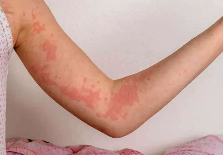 Braccia di un bambino con orticaria, eruzioni cutanee rosse e pruriginose. Immagini di orticaria nei bambini.