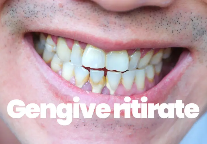 Denti con tartaro e gengive ritirate. Scopri le vitamine per gengive ritirate e migliora la tua igiene orale.