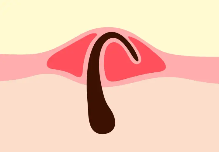 Illustration d'un bouton, montrant un poil pubien courbé sous la peau.