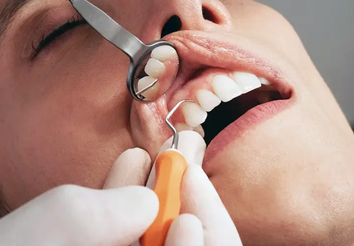 Dettaglio di un intervento di curettage gengivale, con strumento dentale che pulisce la zona tra dente e gengiva.