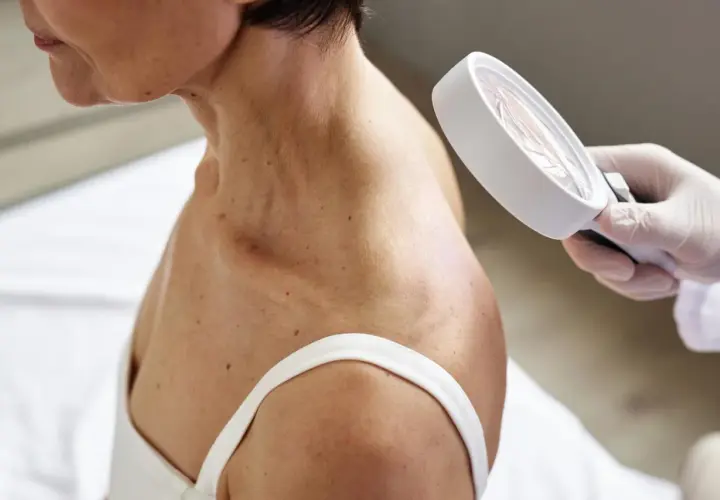 Dermatolog ogląda skórę szyi i ramienia pacjentki przez lupę.