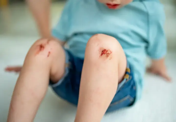 Dziecko z otartymi kolanami. Wczesne objawy tężca mogą obejmować drobne skaleczenia i otarcia, które wymagają uwagi.