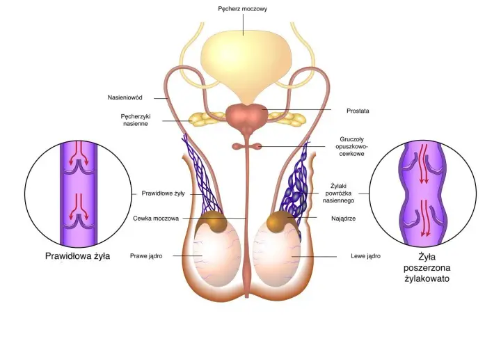 Ilustracja anatomiczna męskiego układu rozrodczego z widokiem na jądra i powrózek nasienny, porównująca prawidłowe żyły z poszerzonymi.