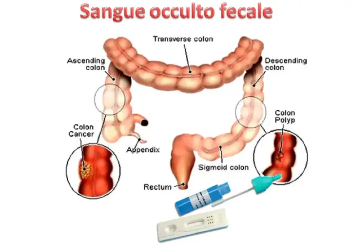 Illustrazione del colon con indicazioni su cancro, polipi e test per sangue occulto nelle feci.