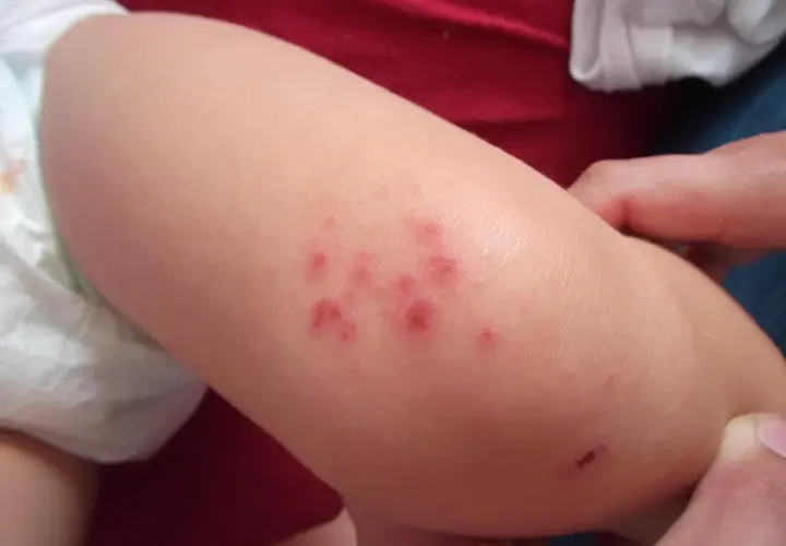 Lesioni cutanee rosse e pruriginose su un braccio di bambino, indicative di impetigine.