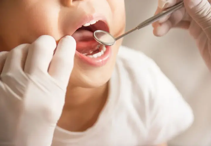 Bambino con bocca aperta esaminata da un dentista con specchietto. Si valuta la possibile ipomineralizzazione dello smalto.