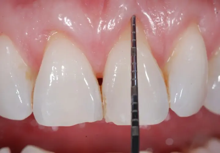 Misurazione della profondità gengivale con sonda parodontale. La recessione gengivale è un problema da non sottovalutare.