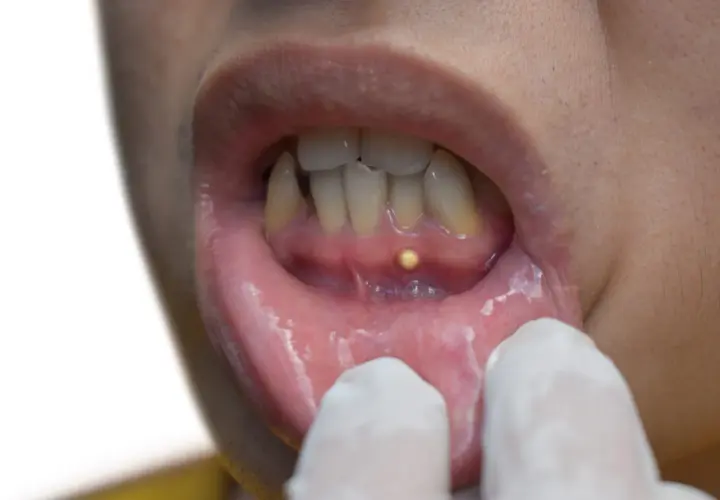 Pequeña protuberancia amarilla en la encía, posiblemente un quiste gingival, examinada con guantes.