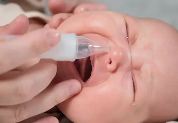 Un bebé recibe un lavado nasal con un aspirador.