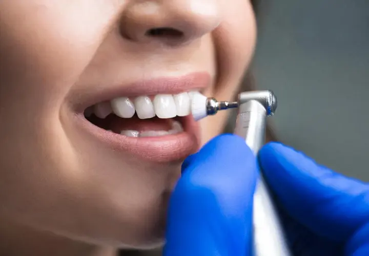 Denti bianchi e sani dopo la detartrasi ultrasuoni. Un dentista con guanti blu pulisce i denti con uno strumento rotante.