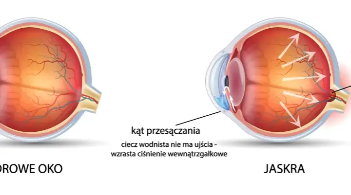 Jak sprawdzić czy mam jaskrę? Objawy i ważne badania, które ratują wzrok