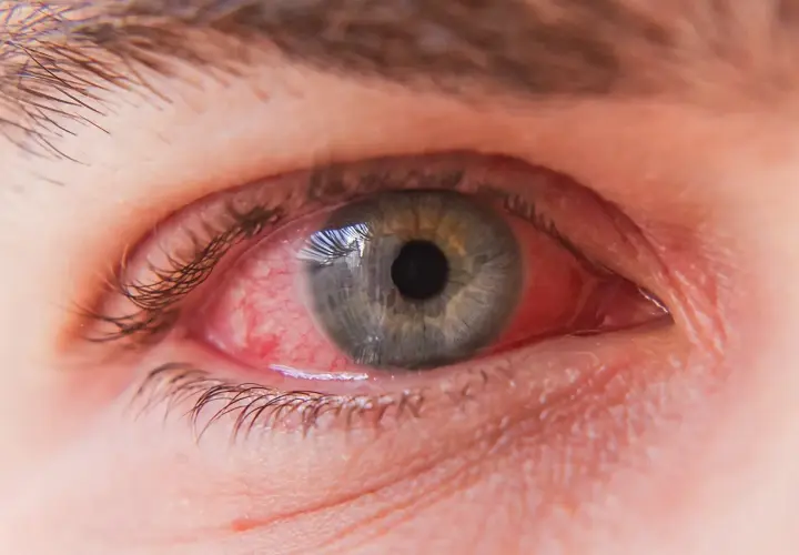 Œil rouge et irrité, signe de conjonctivite. Un traitement est nécessaire pour soulager l'inflammation.
