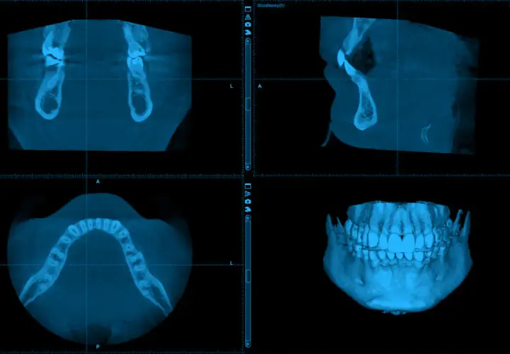 Tomografia zębów cena: szczegółowy obraz szczęki i żuchwy w trzech projekcjach, w tym widok 3D.