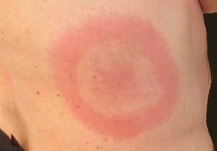 Rött, ringformat utslag på huden, misstänkt allergiska utslag.