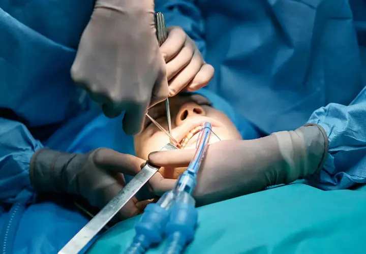Procedimiento dental con anestesia general para extracción de muelas del juicio. Cirujanos operan la boca de un paciente.