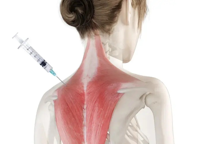 Zastrzyk botoksu w mięśnie karku, by uzyskać efekt "Barbie botox" i wysmuklić sylwetkę.