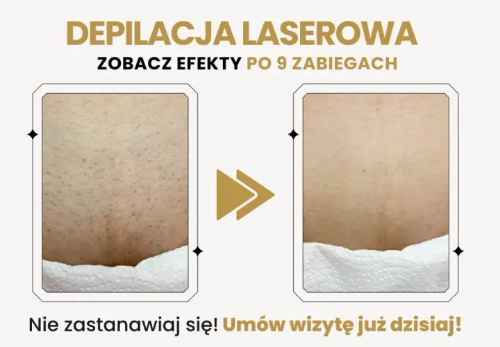 Porównanie skóry przed i po depilacji laserowej bikini.