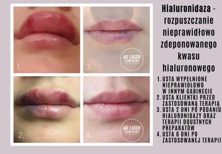 Niezadowolenie po kwasie? Jak przyspieszyć wchłanianie i hialuronidaza
