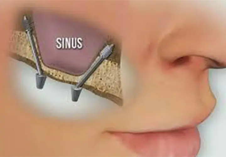 Illustrazione di un sinus lift: due impianti dentali inseriti nell'osso mascellare superiore, vicino al seno mascellare.