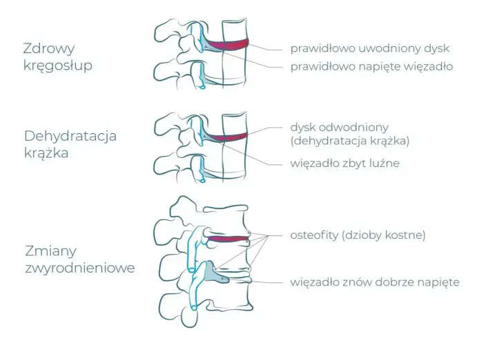 Ilustracja pokazuje zdrowe kręgi, odwodniony krążek i zmiany zwyrodnieniowe, które mogą być spowodowane pracą fizyczną.