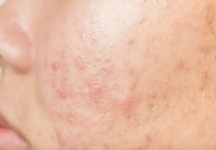Gros plan sur une peau présentant des rougeurs et des imperfections, illustrant la cause de l'acné sur le visage.