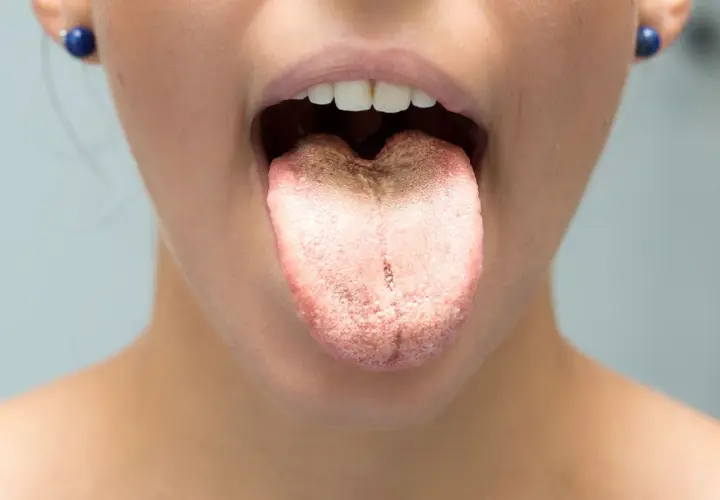 Lingua con patina biancastra e filamenti bianchi in bocca, segno di possibile infezione fungina.