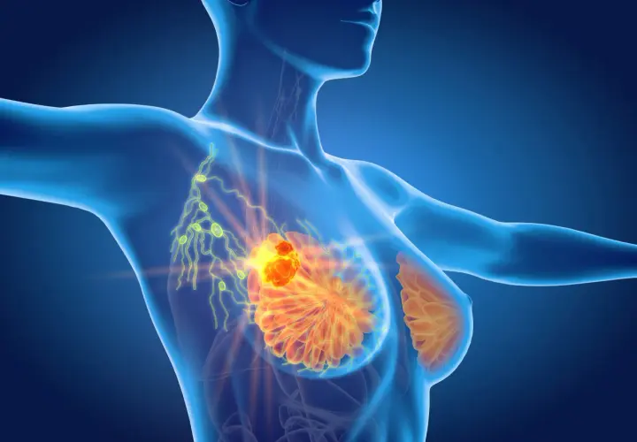 Anatomical rendering showing a tumor in the breast and enlarged lymph nodes, indicating limfadenopatia.