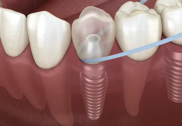 Filo interdentale che pulisce attorno a un impianto dentale. È importante prendersi cura dell'igiene orale, anche se si possono lavare i denti prima di un intervento.