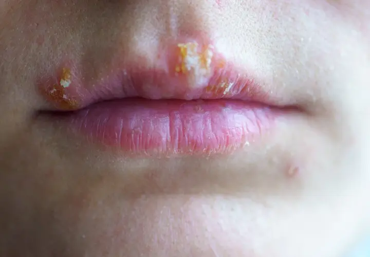 Labios con ampollas y costras, indicativo de herpes labial contagio.