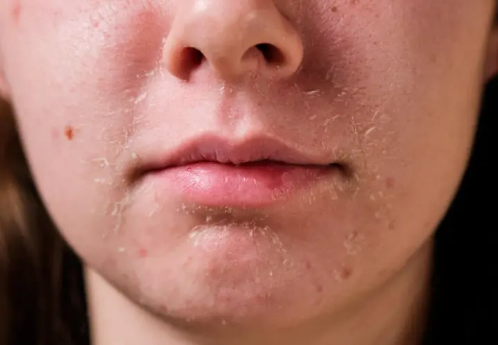 Peau très sèche, craquelée et squameuse autour de la bouche et du nez. Peut-être une réaction à un produit ou un manque d'hydratation.