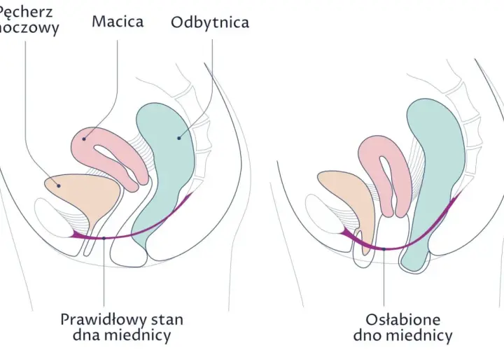 Ilustracja porównuje prawidłowy stan dna miednicy z osłabionym, pokazując, jak wypadanie macicy może wpływać na narządy.